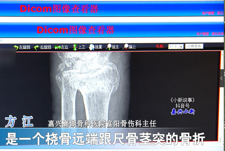 97歲高齡老人，傳統(tǒng)復(fù)位免于手術(shù)3.png